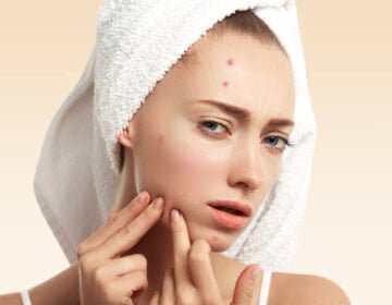 Should I pop out my whitehead pimples?