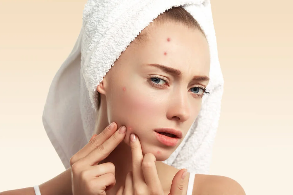 Should I pop out my whitehead pimples? 1 Poping pimples