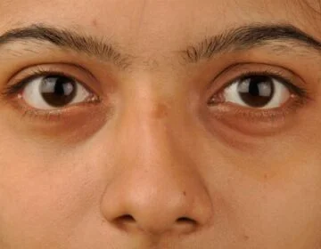 Dark Circles - girlsnbeauty.com