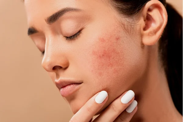 Should I pop out my white head pimples - girlsnbeauty.com