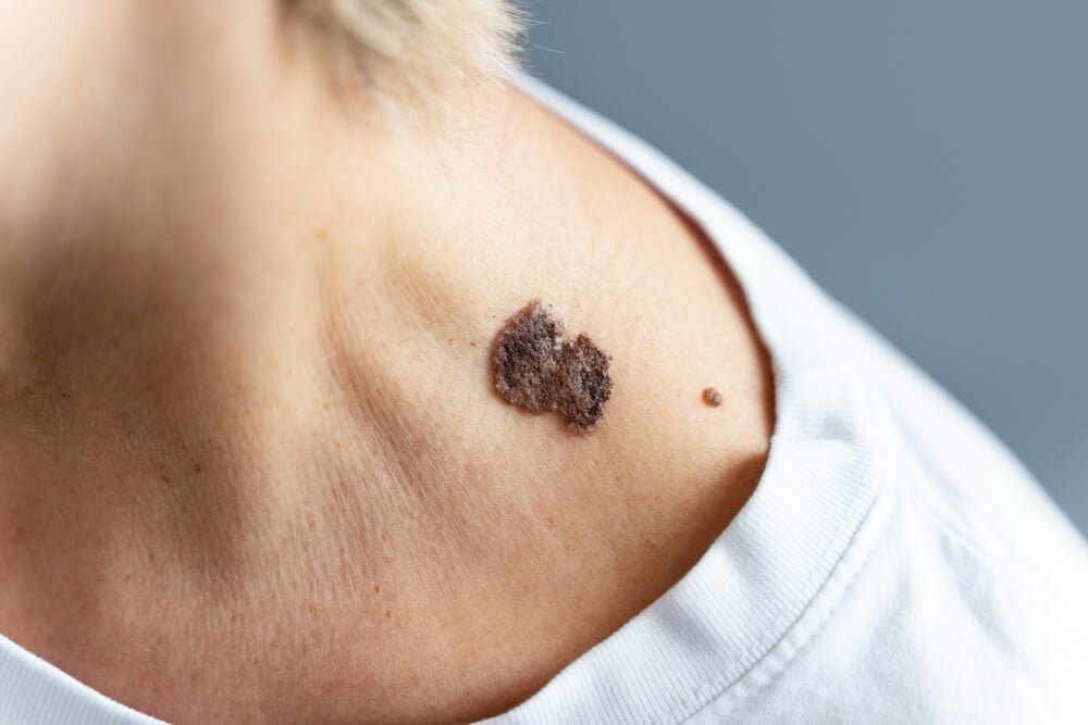 7 never fail ways to remove skin tag in 1 night 1 7 never fail ways to remove skin tag in 1 night