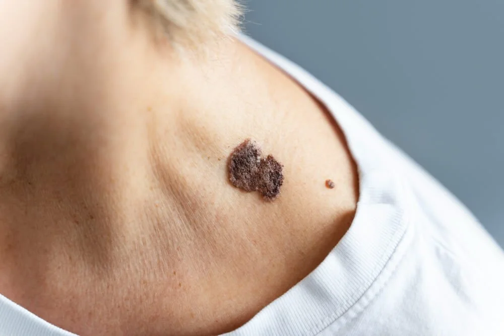 7 never fail ways to remove skin tag in 1 night