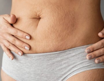 stretch marks-girlsnbeauty.com