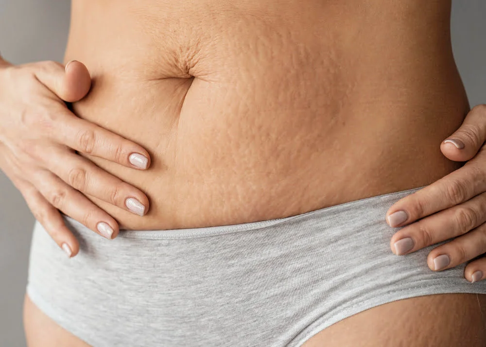 5 Biggest Myths About Stretch Marks 1 stretch marks-girlsnbeauty.com