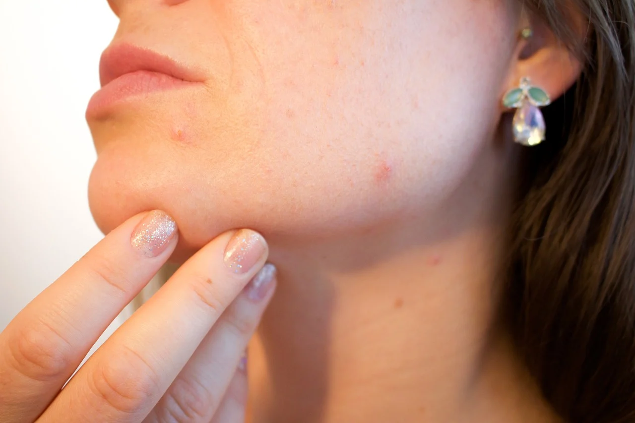 What Happens to Your Skin When You Pop a Pimple, Girlsnbeauty.com