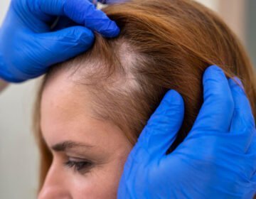 Hair transplant-girlsnbeauty.com