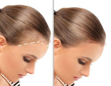 Hairline restoration-girlsnbeauty.com