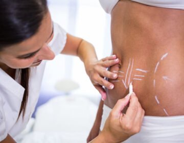 Liposuction scars-girlsnbeauty.com