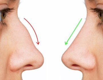 Liquid Rhinoplasty Vs. Surgical Rhinoplasty-girlsnbeauty.com
