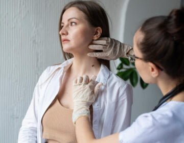 Mole removal-girlsnbeauty.com