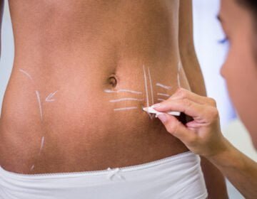 VASER liposuction-girlsnbeauty.com