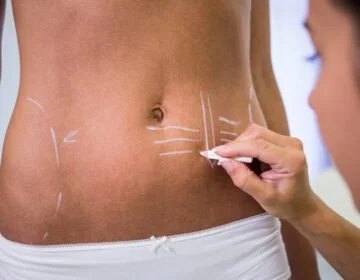 VASER liposuction-girlsnbeauty.com