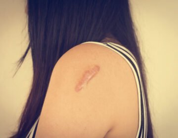keloid scars-girlsnbeauty.com