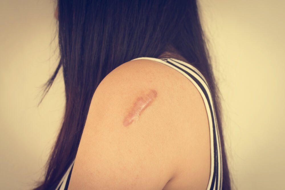 Keloid Scars Everything You Need To Know