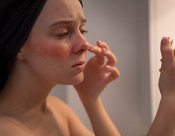 Natural Remedies for Treating Acne- girlsnbeauty.com