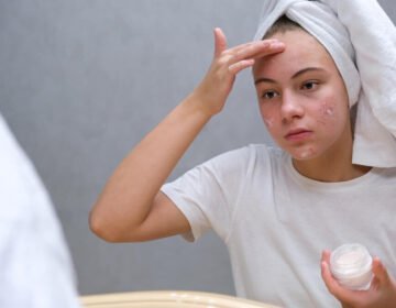 Acne skincare - tips - girlsnbeauty.com