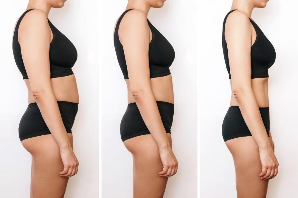 Cryo slim before and after 1