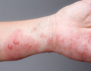 All 7 seven types of Atopic Eczema you need to know - girlsnbeauty.com