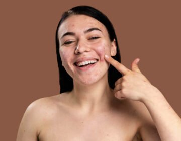 Is pimple popping a good idea - girlsnbeauty.com