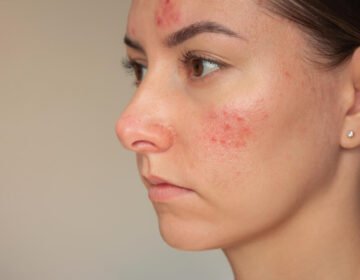 Best skincare tips for managing rosacea-prone skin - girlsnbeauty.com