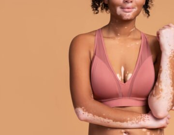 What are the vitiligo causes and how they affect your skin - girlsnbeauty.com