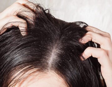 Have a Itchy Head? Find the Best Solutions for Dandruff 14 Have a Itchy Head Find the Best Solutions for Dandruff - girlsnbeauty.com